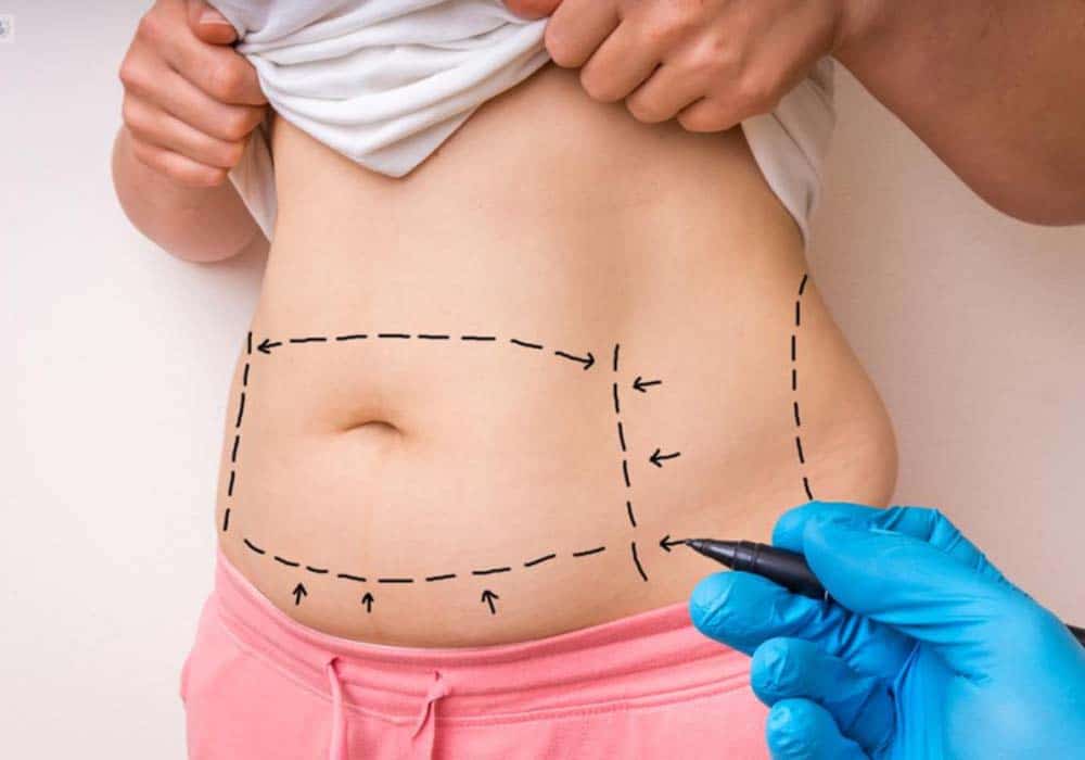 fat reduction on stomach non-invasive